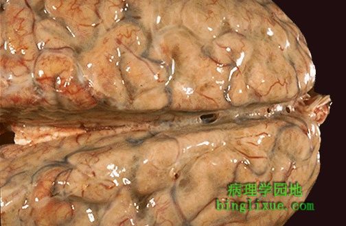 化脓性脑膜炎 化脓性脑膜炎