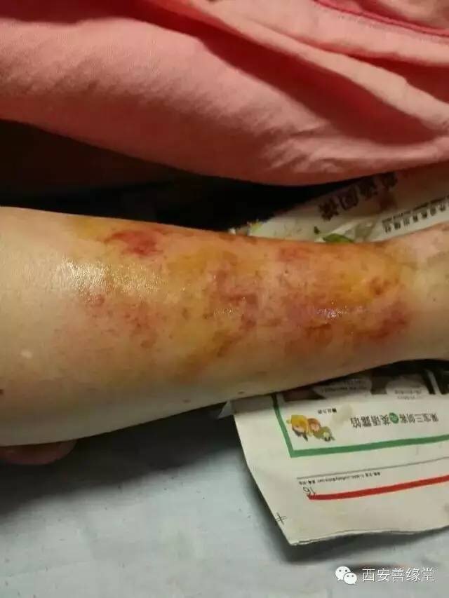 皮肤及软组织感染 皮肤及软组织感染