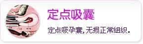 定点取囊 定点取囊