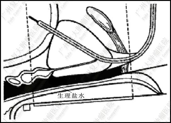 生理盐水 生理盐水