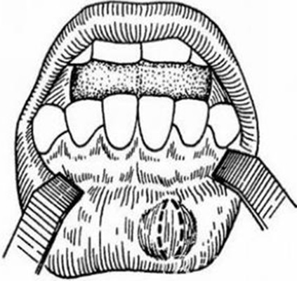 粘液腺囊肿