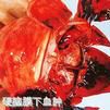 脑水肿