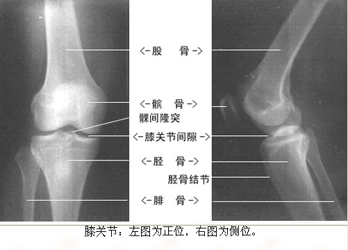 膝关节急性滑膜炎