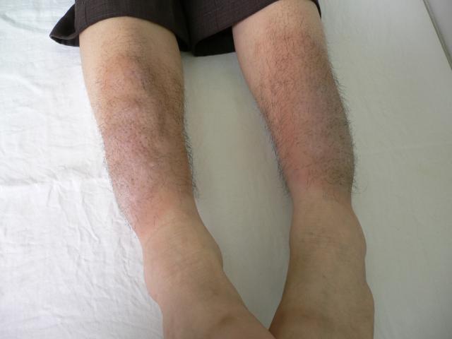 粘液性水肿