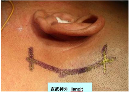 微血管减压术的切口 微血管减压术的切口
