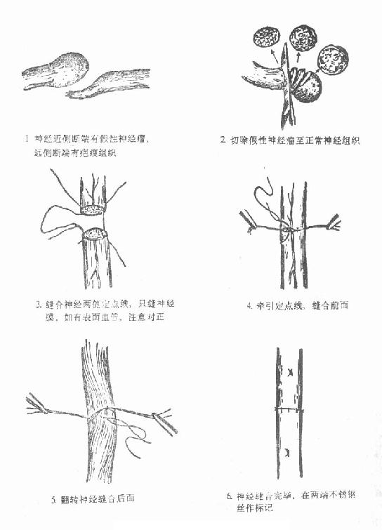 神经损伤 神经损伤