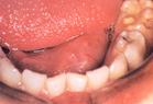 粘液腺囊肿 粘液腺囊肿