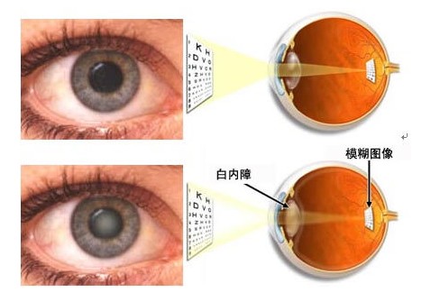 早期白内障 早期白内障