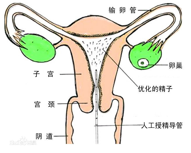 体外人工受精