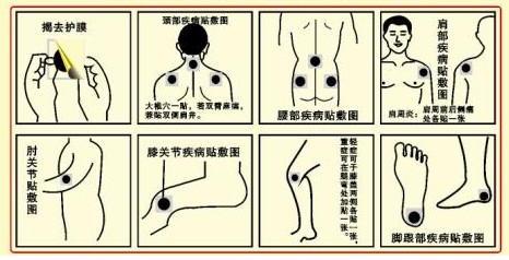 膏药贴敷示意图 膏药贴敷示意图