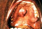 粘液腺囊肿 粘液腺囊肿