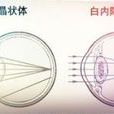 后天性白内障