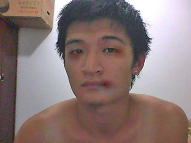 脸肿