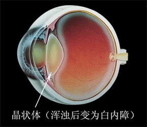 白内障的诊断与治疗 白内障的诊断与治疗