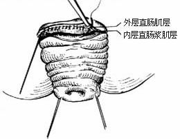 直肠黏膜脱垂的早期症状 直肠黏膜脱垂的早期症状