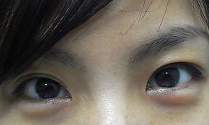 眼睛浮肿 眼睛浮肿
