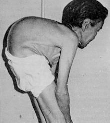 1955-1972年骨痛病事件 1955-1972年骨痛病事件