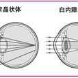 併发症白内障