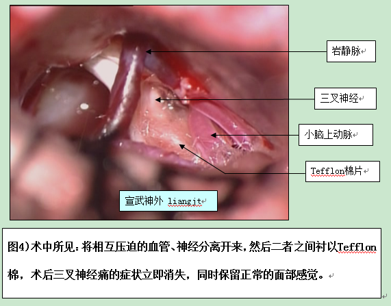 三叉神经痛(脸痛) 三叉神经痛(脸痛)