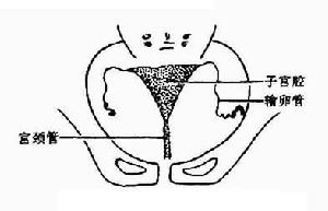 女性生殖器官结核 女性生殖器官结核