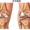 骨质增生病