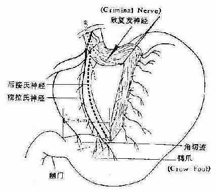 高选择性胃迷走神经切断术 高选择性胃迷走神经切断术