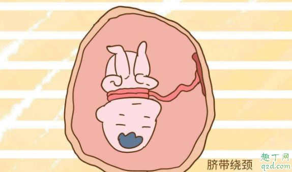 脐带绕颈顺产有危险吗 胎儿脐带绕颈要注意什么1