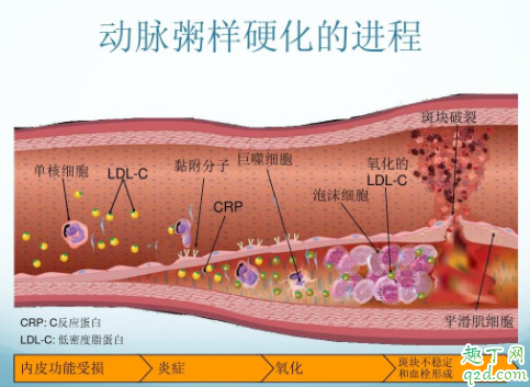 冠心病可以治疗除根吗 冠心病要做手术吗2