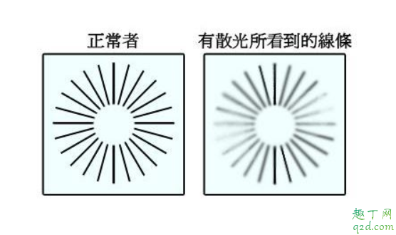 散光有假性和真性吗 眼睛散光应该怎么治疗2