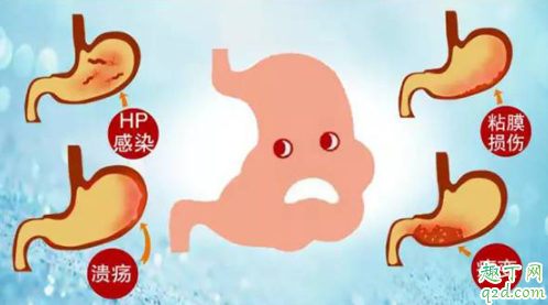 胃癌是不是必须开刀 胃癌症会不会传染2