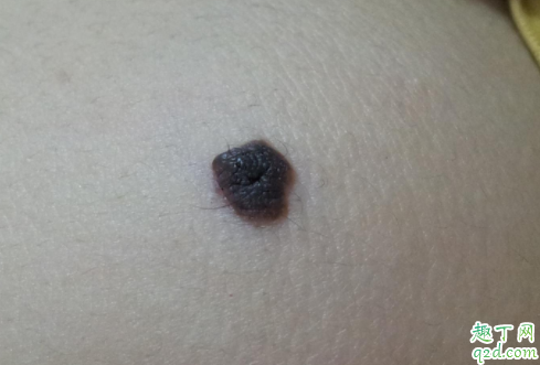 脸上长痣是缺乏维生素吗 痣上长毛好不好4