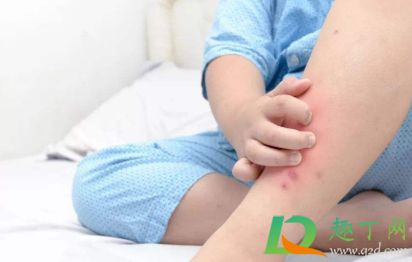 毒蚊子咬了酒精可以消肿止痒吗1