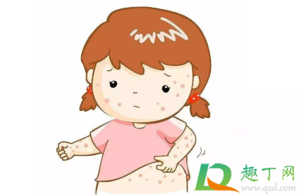 痱子怎么消除小妙招1