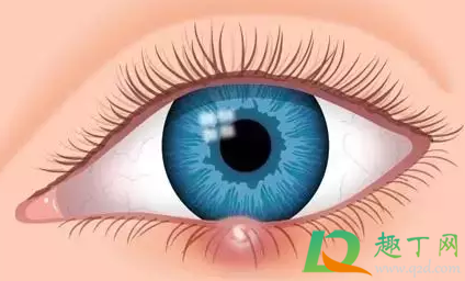 眼睛长针眼了怎么办才能消肿2