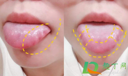 齿痕舌头怎么能好2