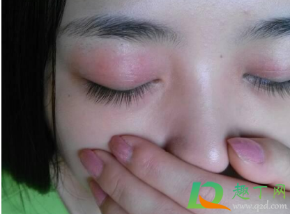 眼皮发痒红肿是咋回事3